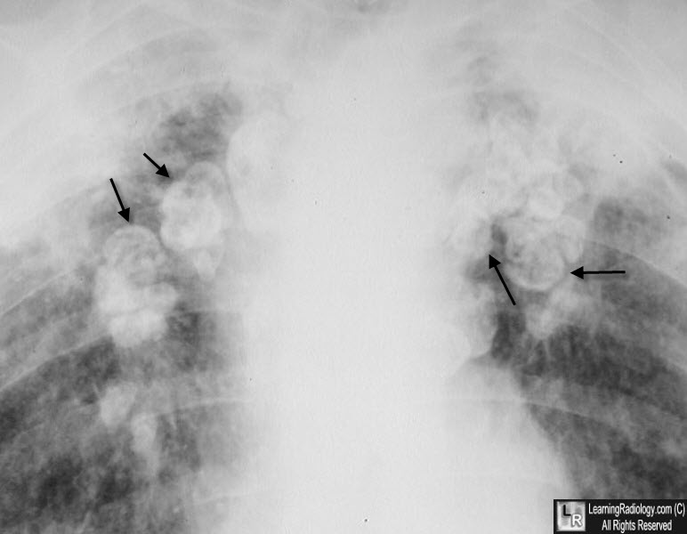 eggshell calcification, silicosis